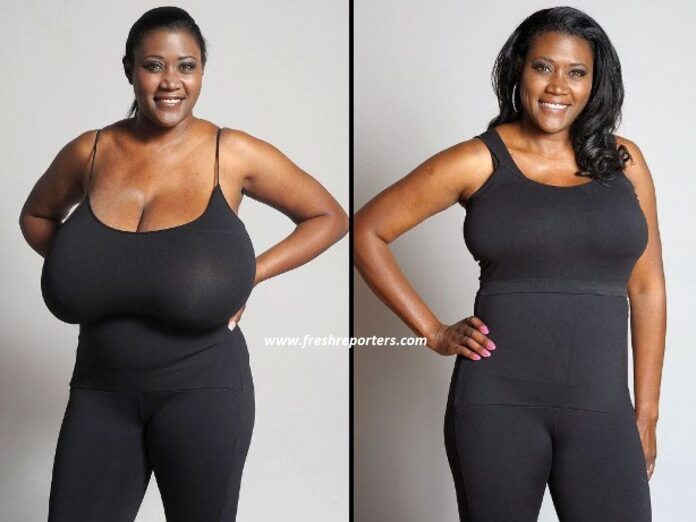 breast reduction recovery week by week