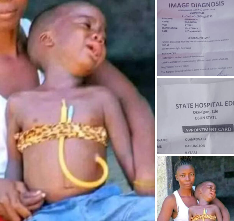 Father Cries Out, Seek ₦500,000 For 10-year-old Son’s Surgery